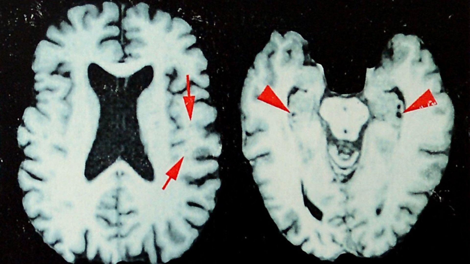Up to 97% of Deceased NFL Players Suffered Brain Disease, Study Finds